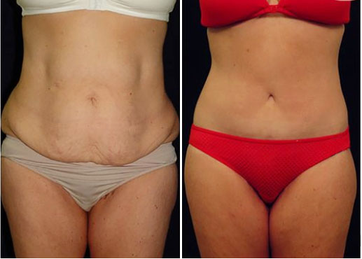 addominoplastica intervento prima e dopo