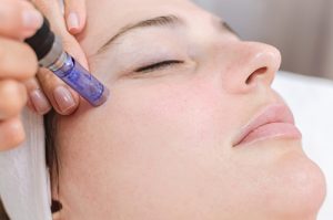 trattamento di microneedling